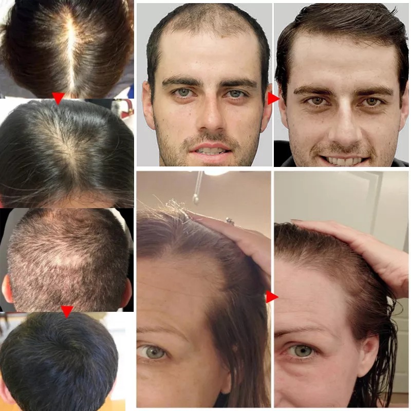 Hair Growth Essential Oil Ginger Hair Lost Solution Serums Fast Scalp Hair Care Treatment For Men Women 20ml
