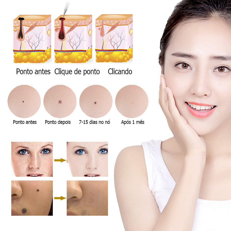 (White) Electric Laser Plasma Pen Mole Removal Dark Spot Remover Skin Wart Tag Remover Multi Speed Level Adjustable Skin Care Home Use USB Charging.
