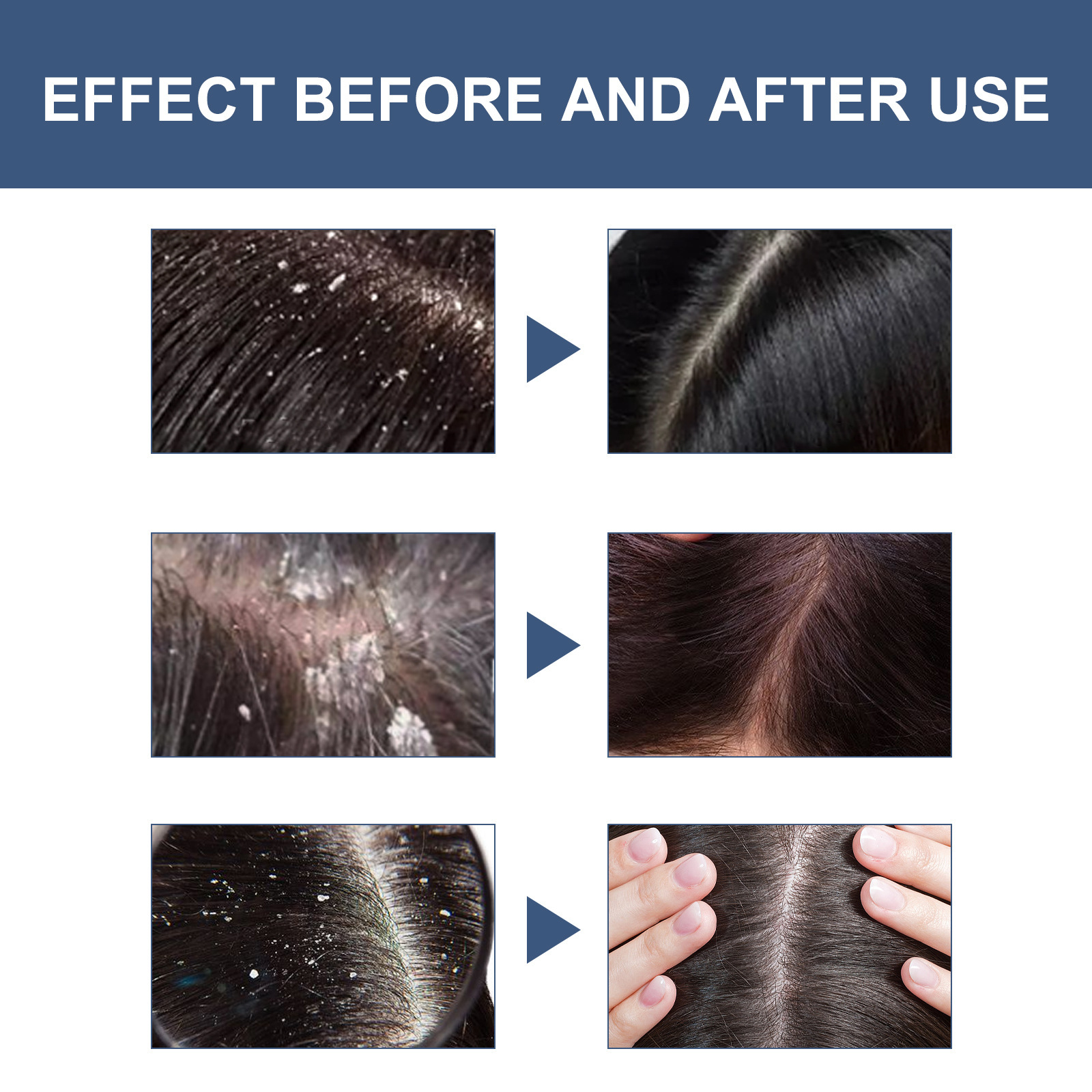 Scalp Exfoliating Scrubs Hair Scratcher Scalp Oil Nutritional Effectively Repairs Damaged Dry Hair Restore Smoothness Promote Scalp Cleanse Treatment