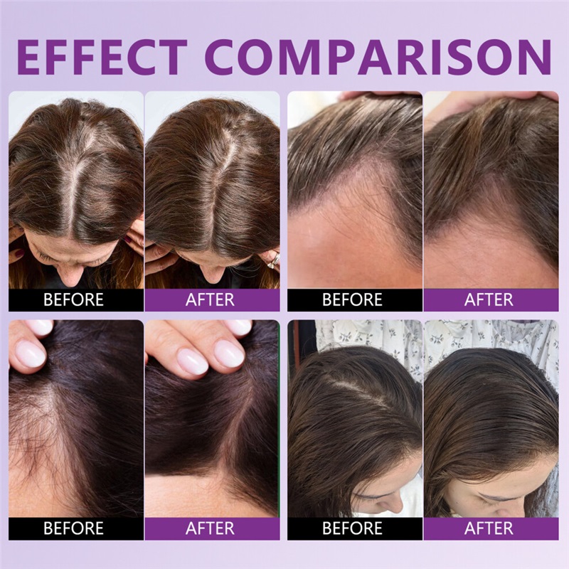 2PCS 60ML Minoxidil 5% Rosemary and Biotin Hair Spray Hair Growth Spray