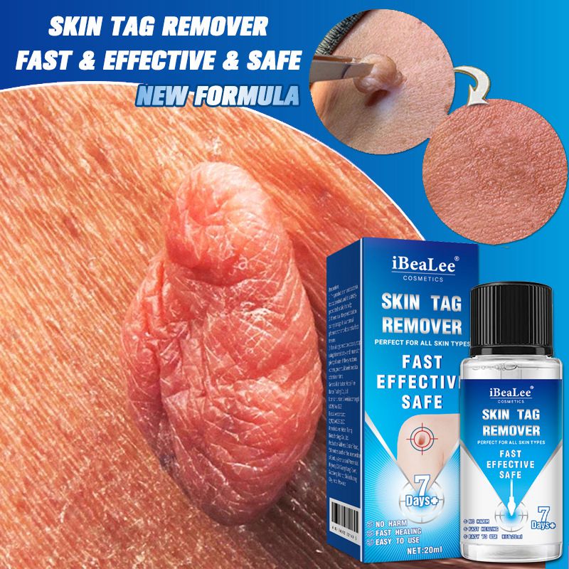 iBeaLee 20ml Skin Tag Remover Fast Effective Safe