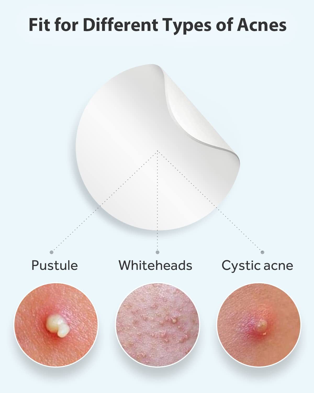 Hydrocolloid Acne Patches Covering Sticker Facial Invisible Closed Comedone Blemish Patches Acne Clearing Waterproof Breathable for Acne Prone Skin Repair