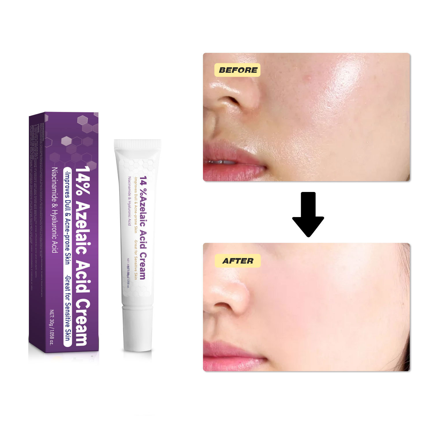 14% Azelaic Acid Cream Skin Care Treatment for Blemishes and Redness Home Use Natural 30g