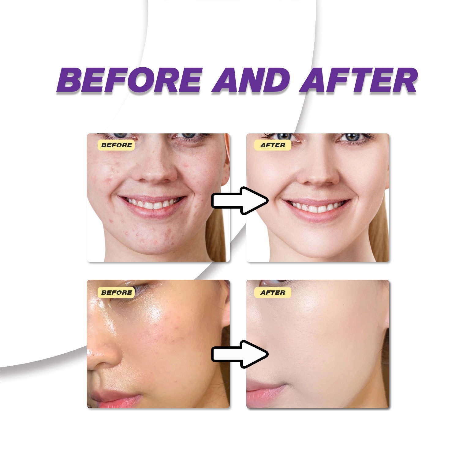 14% Azelaic Acid Cream Skin Care Treatment for Blemishes and Redness Home Use Natural 30g