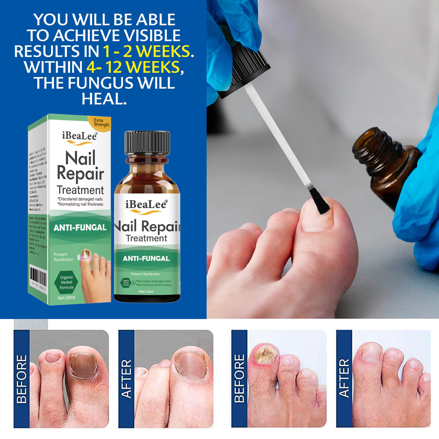 iBeaLee Nail Fungus Treatment Solution Liquid Toenail Feet Care Oil Anti-Infective Essence Paronychia Onychomycosis Repair Serum 20ml