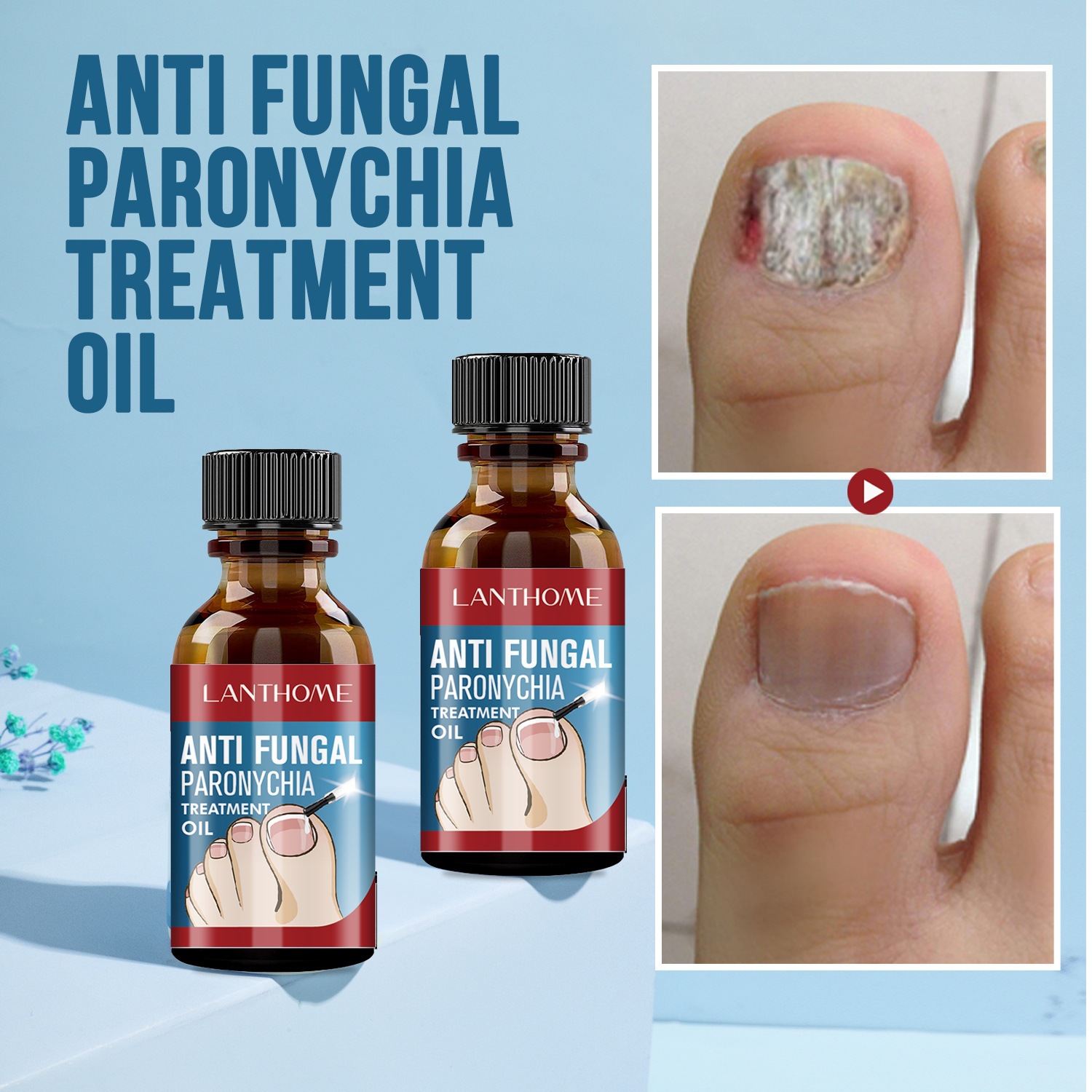 Lanthome Fungal Nail Renewal Treatment For Nail Health Strengthening And Care Solution 10ml