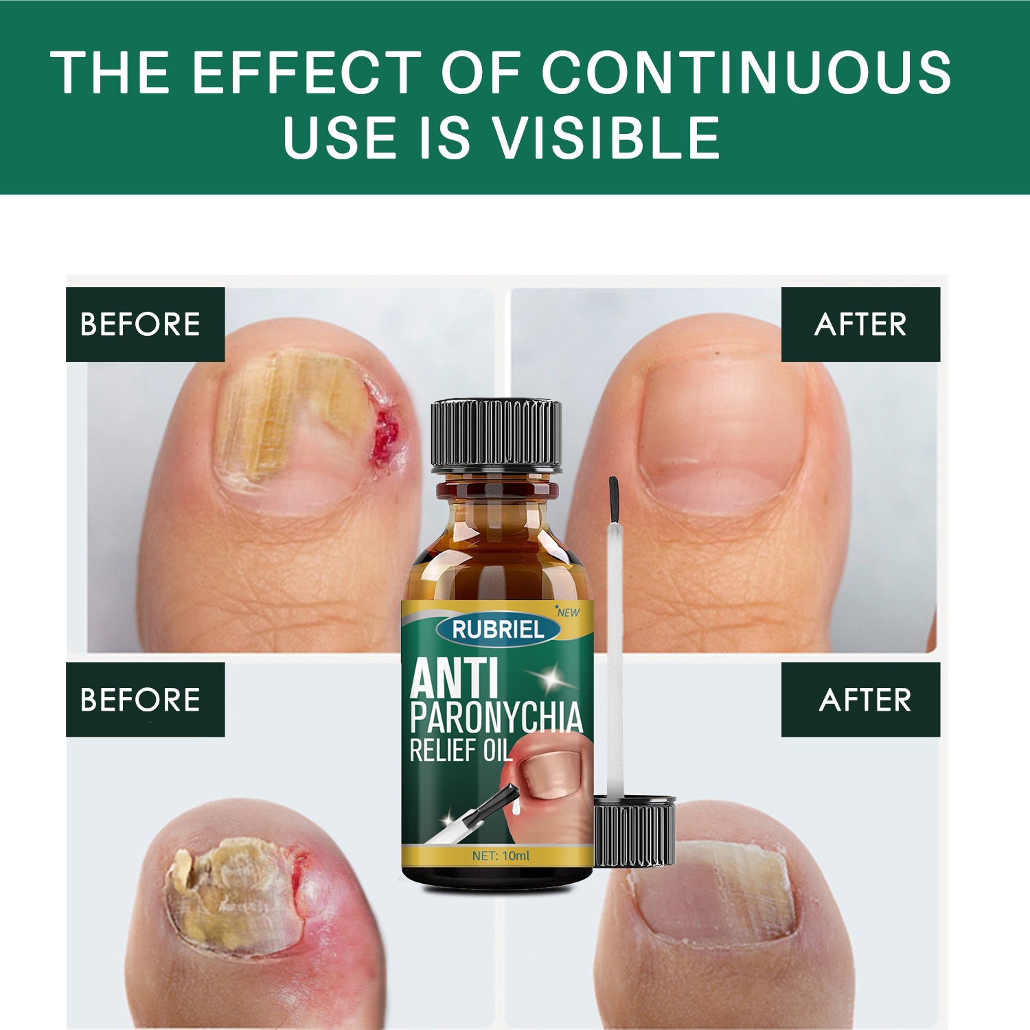 Nail Repair Solution Moisturising Cleansing Treatment for Toenail and Fingernail Care Daily Home Use