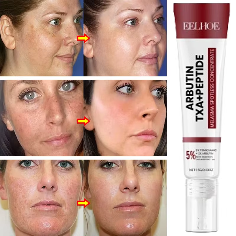 EELHOE Cream Nicotinamide Moisturizes Cream Whiten Freckle Cream Melasma Dark Spots Pigmentation Removal Fade Stain Melanin Repair Brighten Face Skin Care
