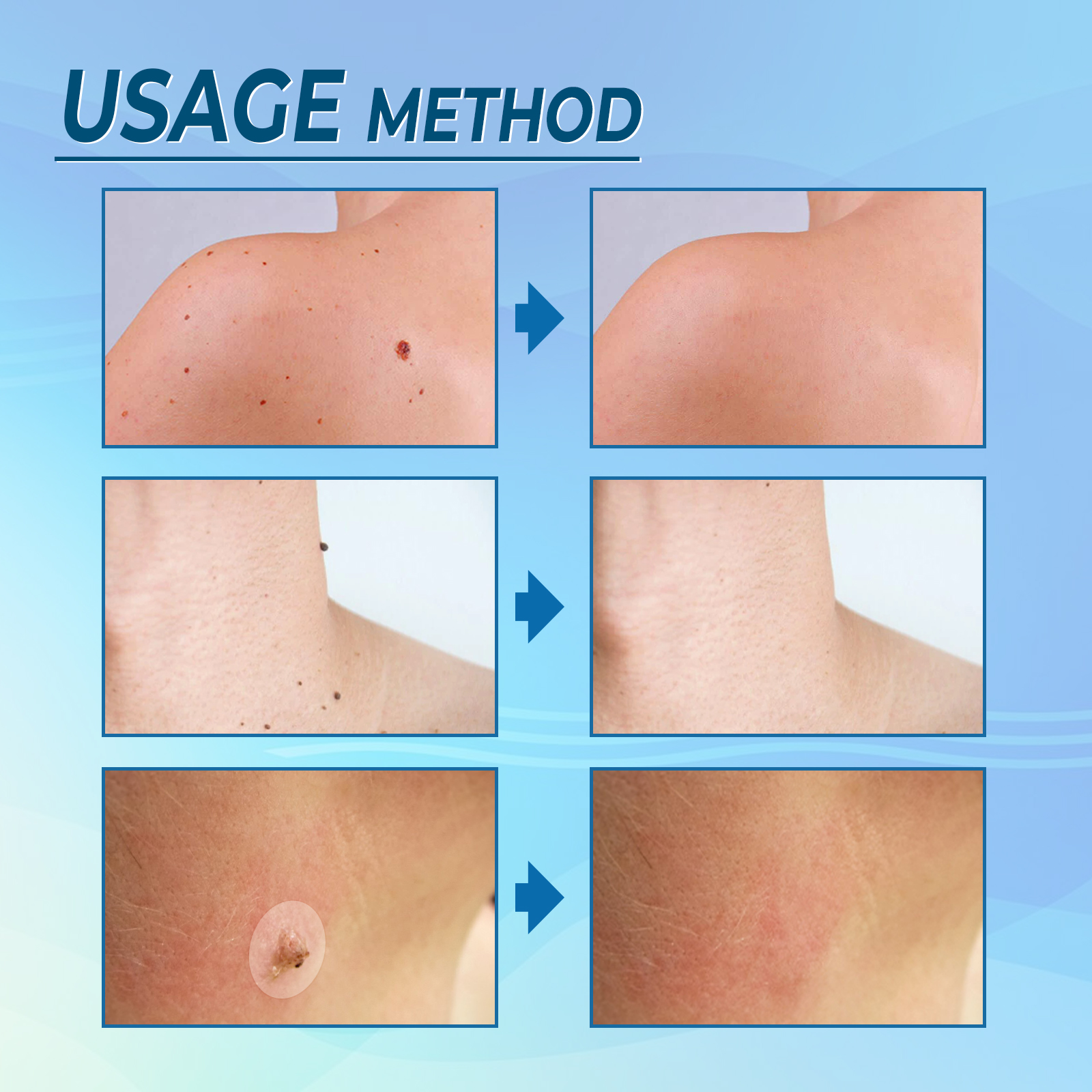 Skin Tag Remover Patch For Moles Warts Corns And Skin Imperfections Gentle Exfoliating Daily Care Treatment