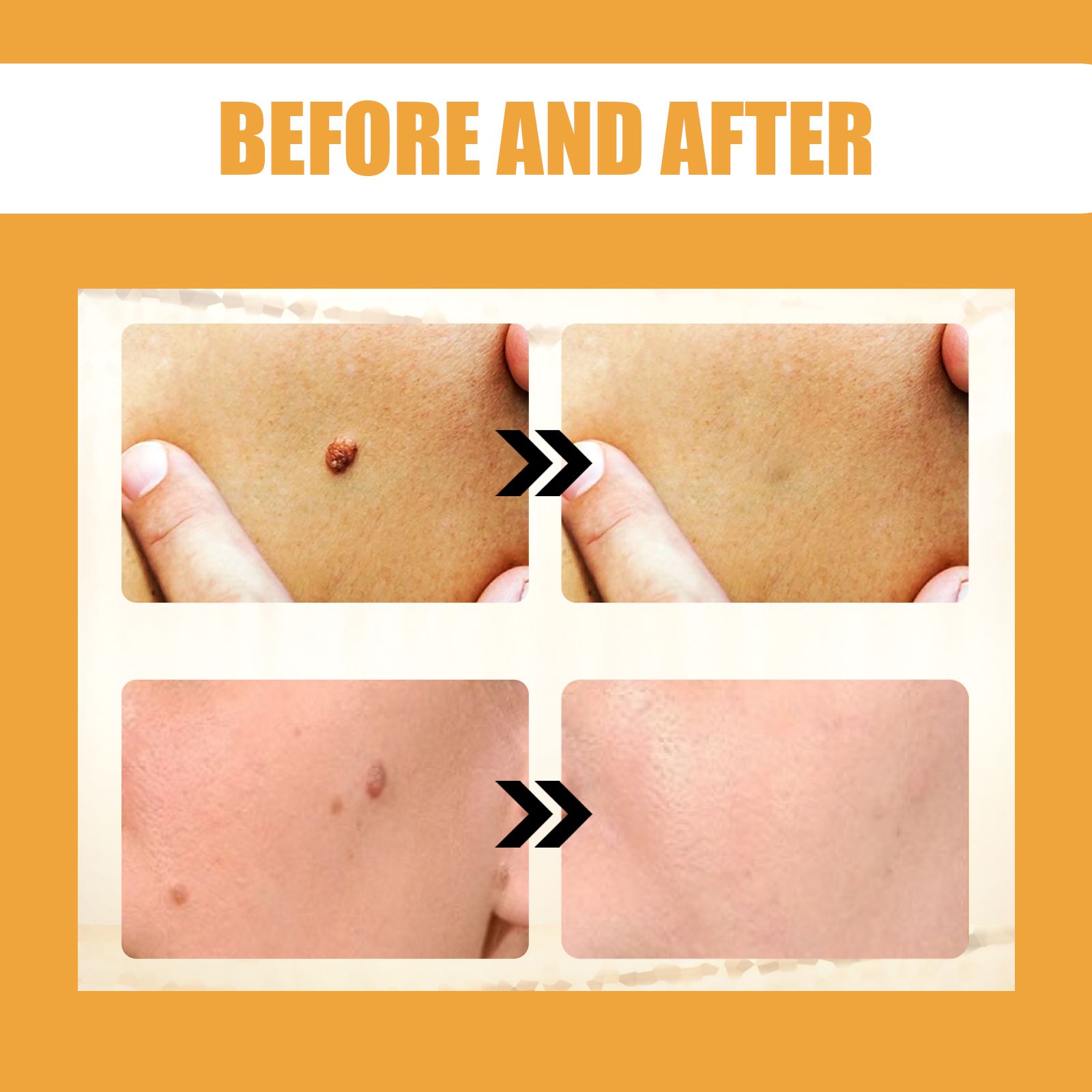 Bee Venom Skin Tag And Wart Care Balm For Smoothing And Daily Skin Care