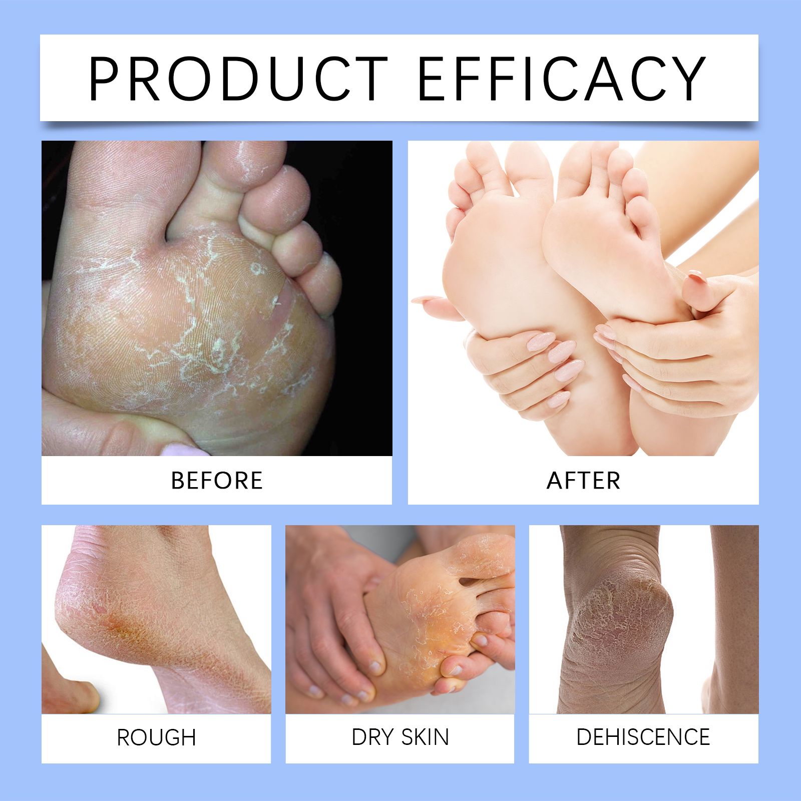 Urea Foot Cream With Coconut Oil And Salicylic Acid For Dry Skin And Daily Foot Care