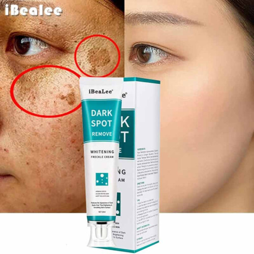 Whitening Freckle Cream Remove Melasma Acne Dark Spot Skin Care 20ml