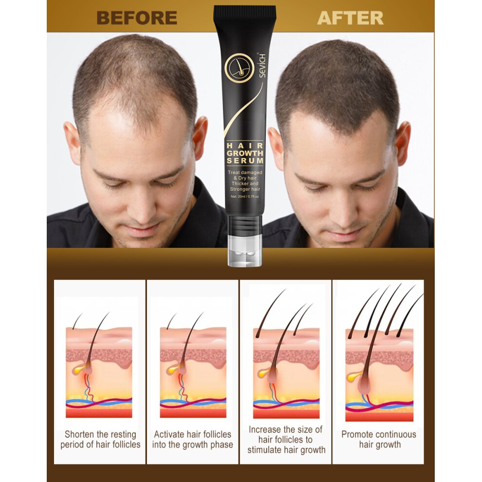 Sevich Hair Growth Oil Ginger Extract Growing Serum Prevent Hair Loss Care Scalp Massage Roller Treatment Thickener Essence 20ml