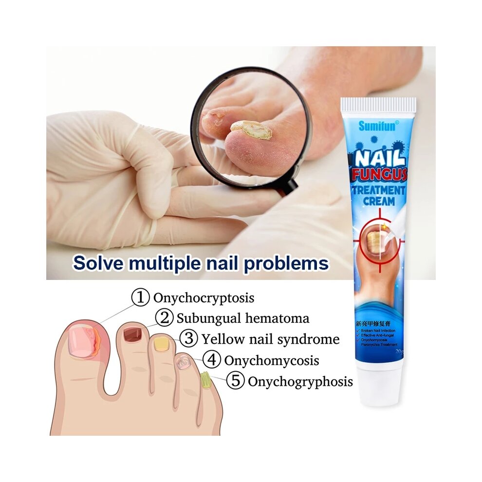 Herbal Toe Nail Fungus Treatment Cream Onychomycosis Paronychia Antibacterial Anti Fungal Infection Repair Ointment