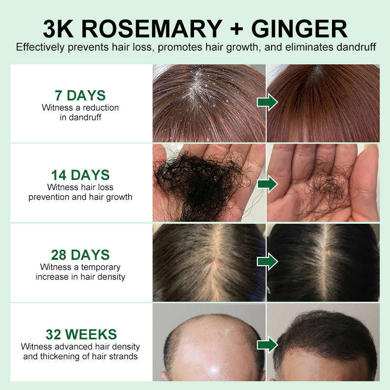 PURC Rosemary Oil Hair Growth Products for Man Women Ginger Anti Hair Loss Fast Regrowth Thicken Essential Oils Hair Serum   Scalp Treatment Hair Care