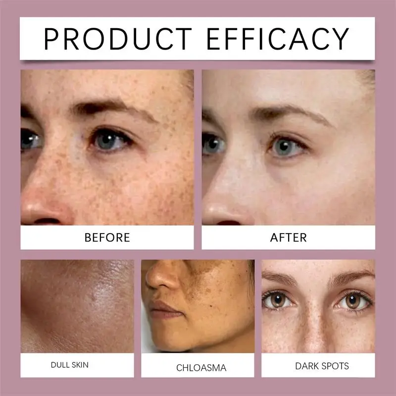 EELHOE Cream Nicotinamide Moisturizes Cream Whiten Freckle Cream Melasma Dark Spots Pigmentation Removal Fade Stain Melanin Repair Brighten Face Skin Care