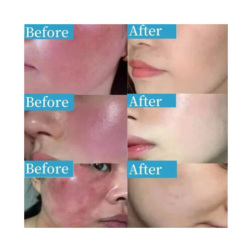 Repair Facial Redness Serum Instant Spider Vein Remove Sensitive Skin Sooth Anti Redness Rosacea Treat Lotion Korean Cosmetics