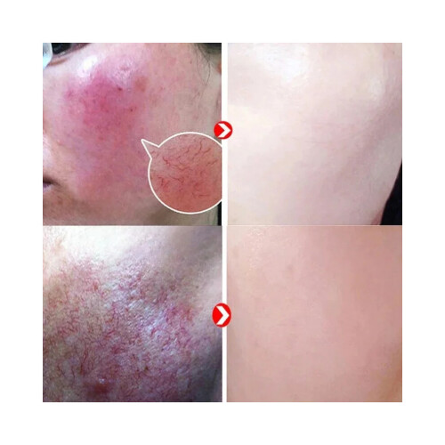 Repair Facial Redness Serum Instant Spider Vein Remove Sensitive Skin Sooth Anti Redness Rosacea Treat Lotion Korean Cosmetics