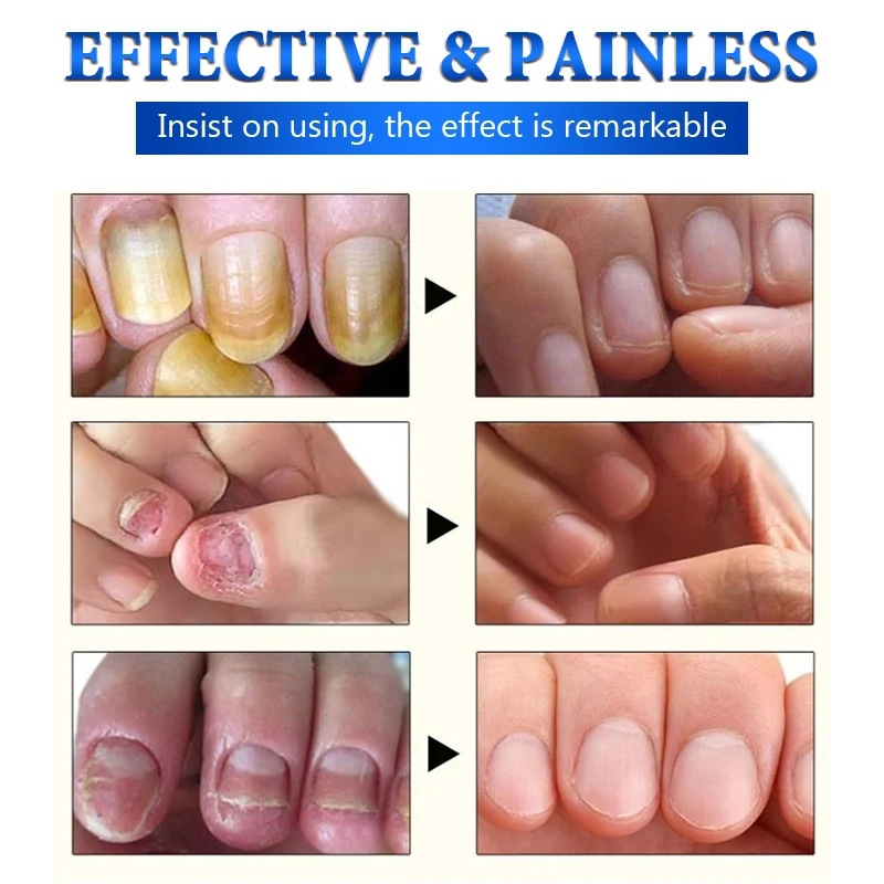 SUAI Nail Cuard Nail Fungal Treatment Herbal Essential Feet Repair Liquid Toe Nail Fungal Removal Anti Infection Paronychia Onychomycosis Tools 10ml