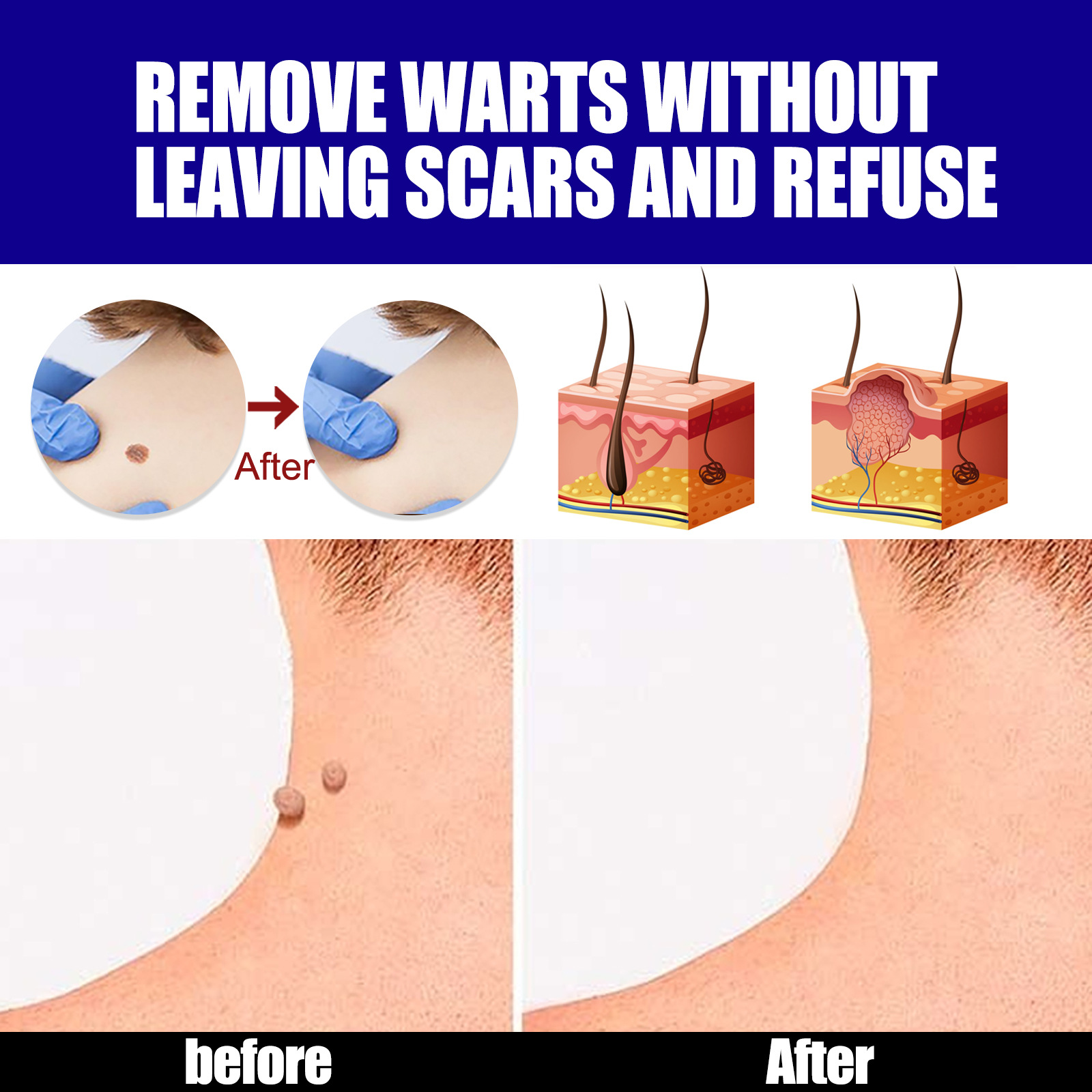 Ouhoe Skin Tag Remover Warts Remover Ointment Mole Remover Cream Mole Corrector Safe Painless Remove Skin Tag Callus Skin Treatment Ointmen