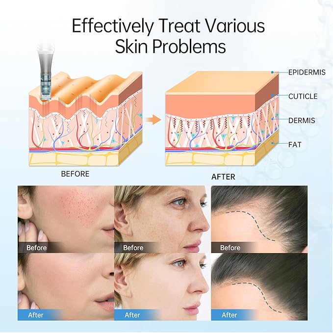 (M8) Dr.Pen M8 Microneedling Pen Wireless Micro Needling Devices Skin Care Tool Kit Face Body Acne Scars Wrinkles 5pcs 16pin 5pcs 36pin Replacement Cartridges