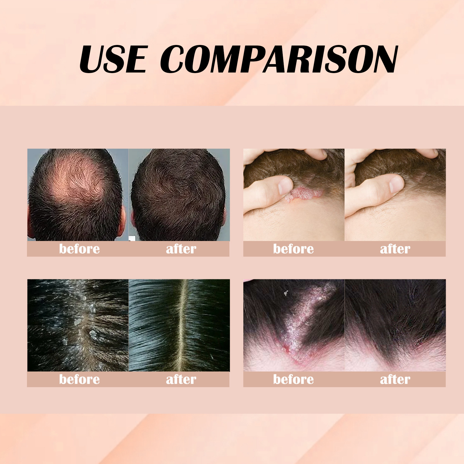 Hair Serum Psoriasis Dandruff Treatment for Scalp Oil Anti Itching Follicle Booster Stimulator Moisturizes Smoothing Nourishing