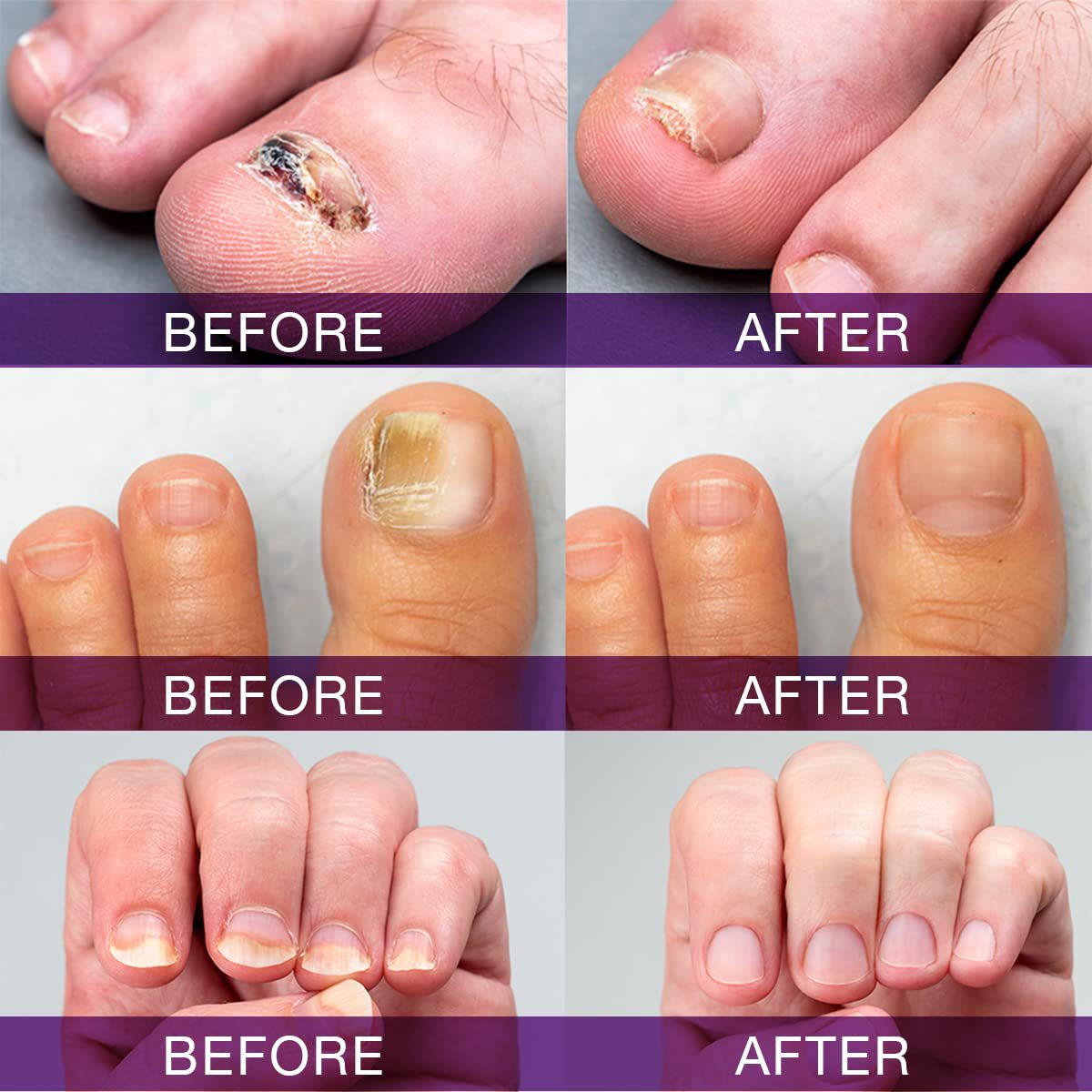 iBeaLee Nail Fungus Treatment Onychomycosis Repair Liquid Anti-Infective Oil Essence Serum Hand And Foot Care Supplies for Men Women 20ml