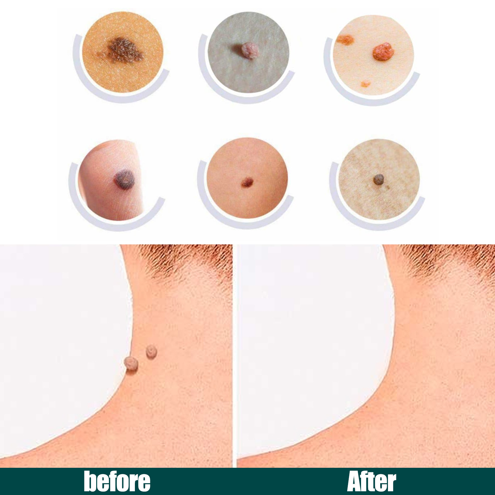 Skin Tag Patches Mole Wart Remover Skin Care Removal 144pcs Patches Kit Fast and Easy Operate Skin Home Removal Tool Face and Neck Repair Daily Care