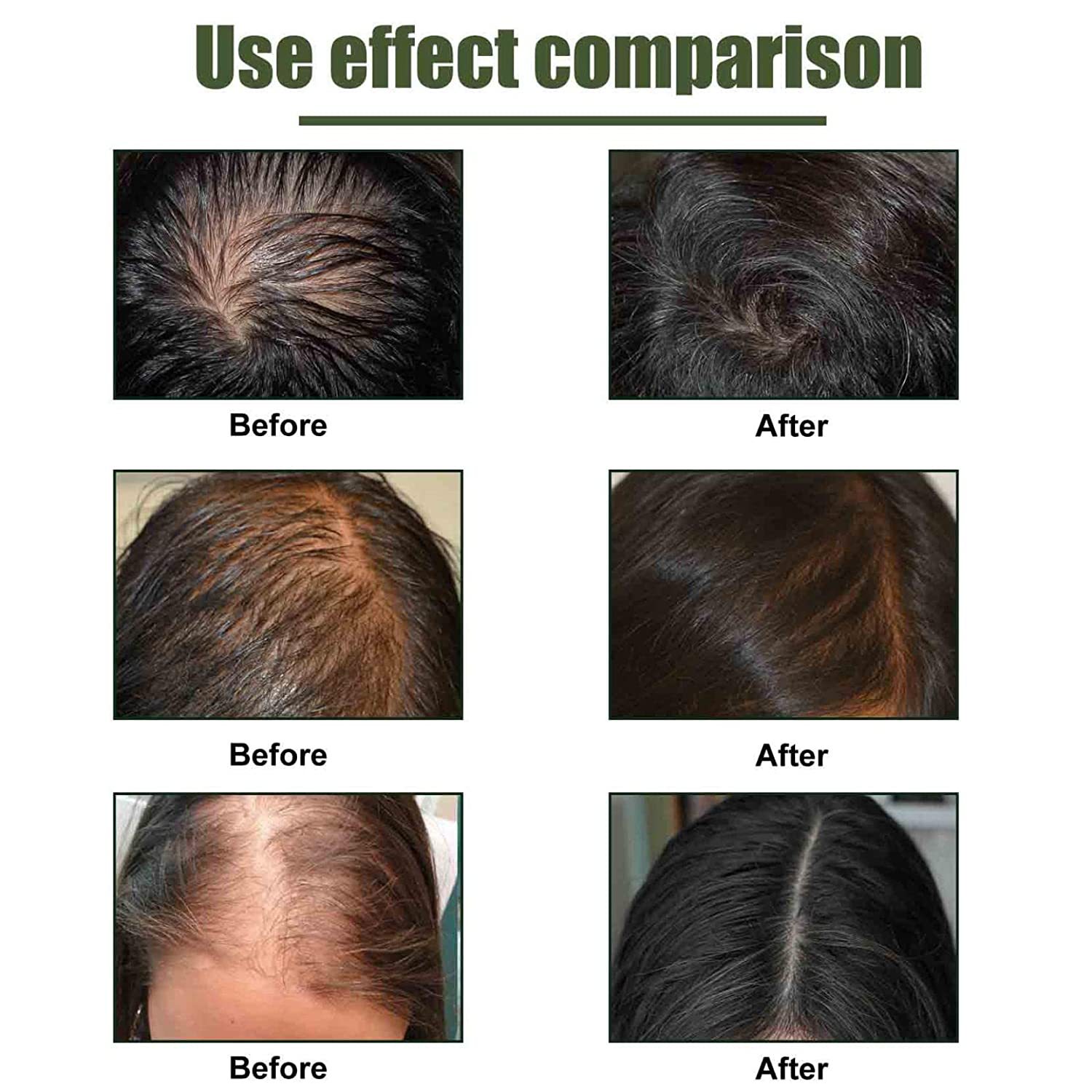 iBeaLee Hair Vitamin Hair Growth Serum Treatment Anti-Hair Loss Preventing For Thinning Hair Thickening Reawakening Beard Hair Care