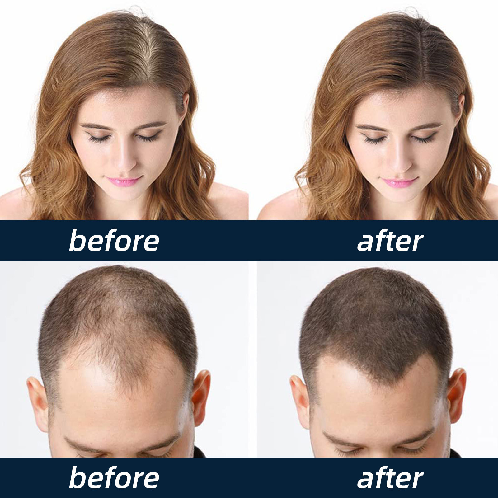 Hair Growth Solution Spray Hair Regrowth Thinning Serum Spray Hair Care Scalp Treatments Products for Stronger Thicker Longer Hair Anti Hair Loss 30ml
