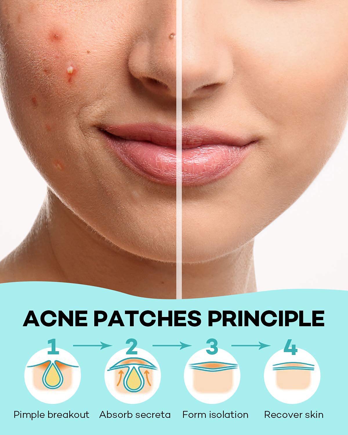 Hydrocolloid Acne Patches Covering Sticker Facial Invisible Closed Comedone Blemish Patches Acne Clearing Waterproof Breathable for Acne Prone Skin Repair