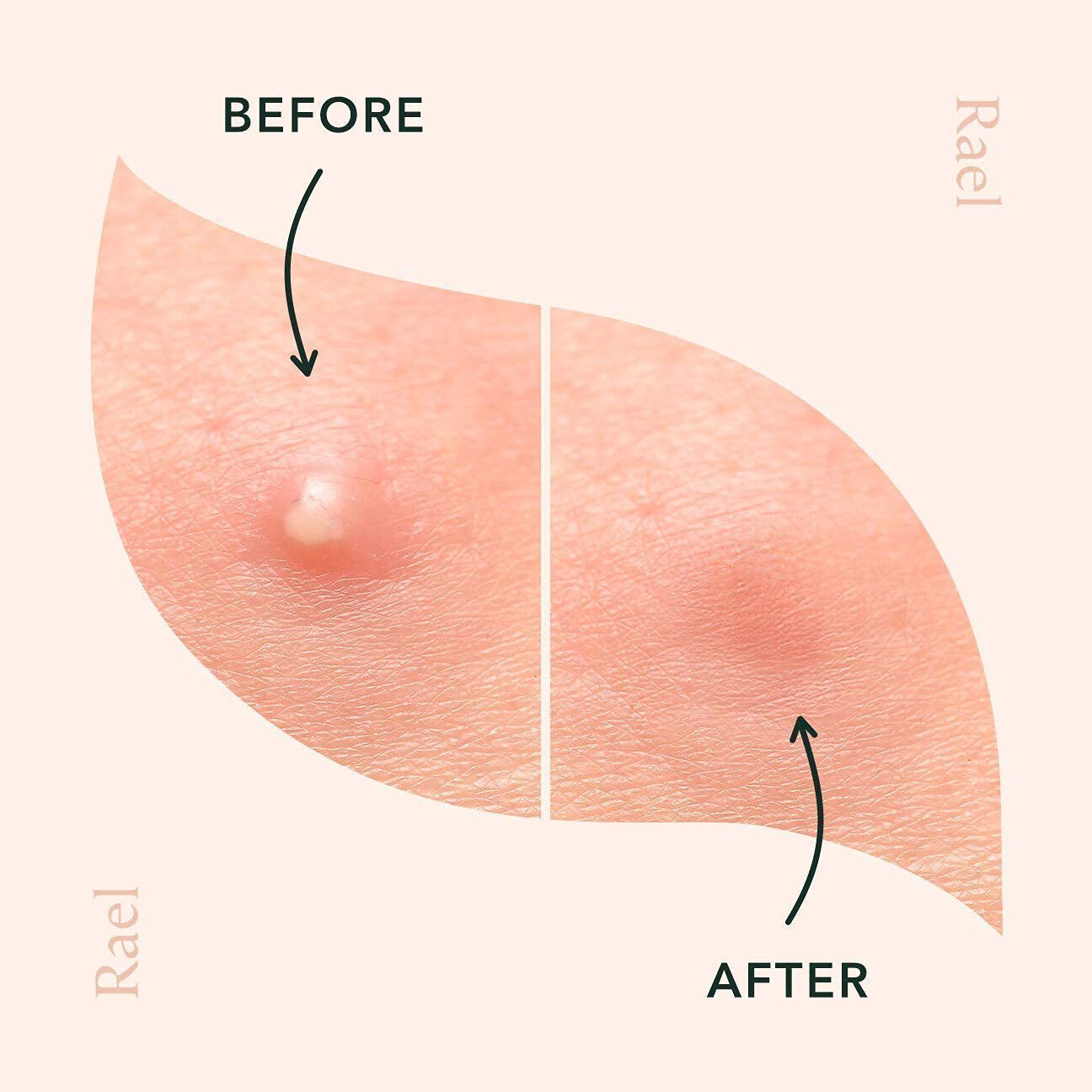Tea Tree Oil Acne Patches Invisible Makeup Net Acne Spot Treatment Acne Pimple Patch For Blemishes Sticker For Face And Skin Hydrocolloid Patch Gifts