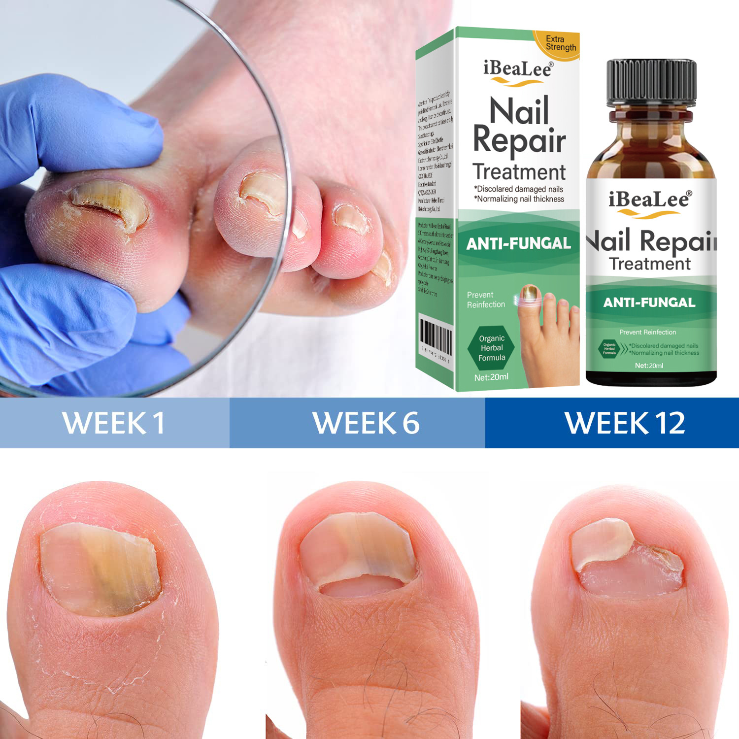 iBeaLee Nail Fungus Treatment Solution Liquid Toenail Feet Care Oil Anti-Infective Essence Paronychia Onychomycosis Repair Serum 20ml