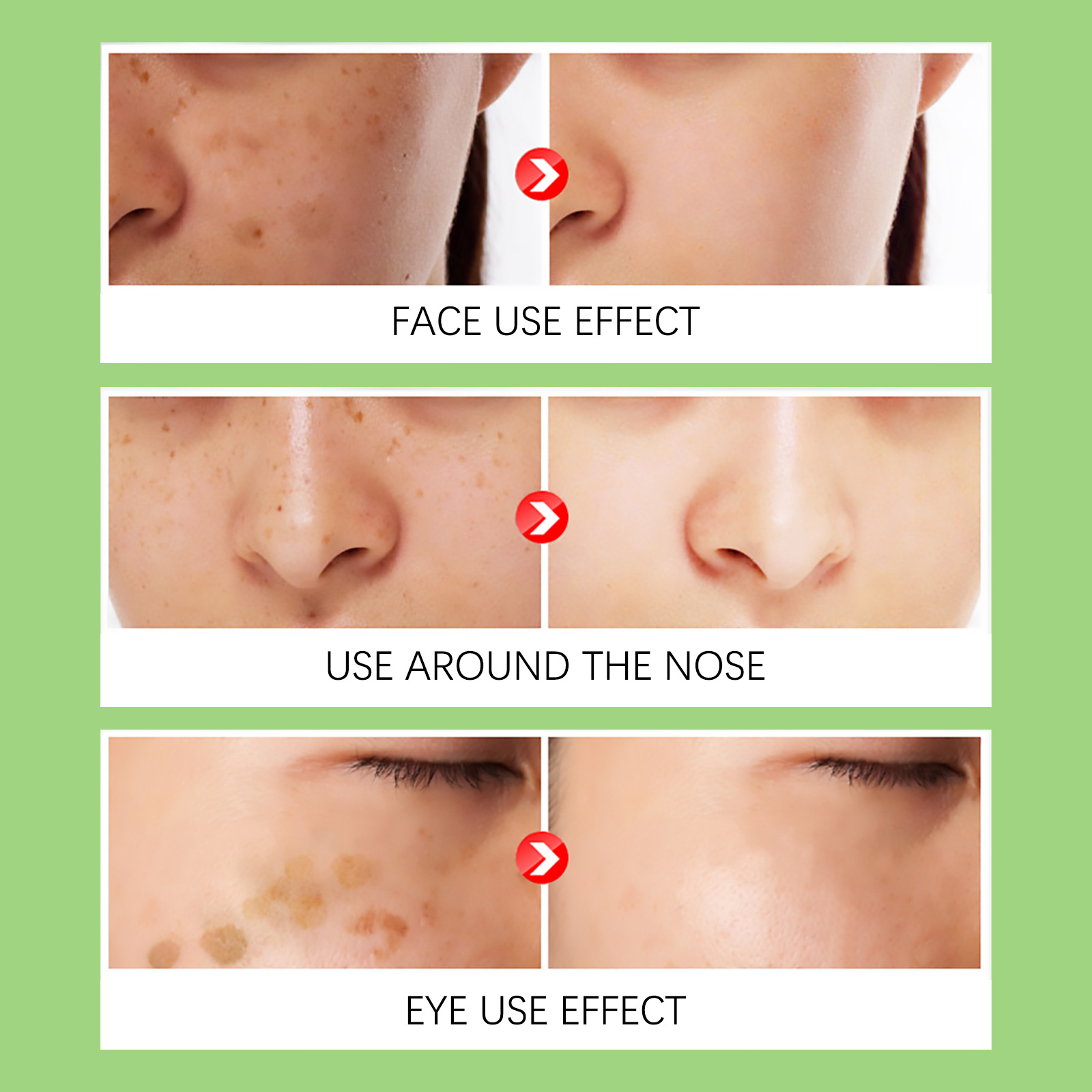 Whitening Freckles Cream Face Remove Melasma Dark Spots Lighten Melanin Melasma Remover Moisturizing Brighten Skin Care 30ml