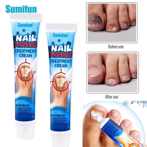 Herbal Toe Nail Fungus Treatment Cream Onychomycosis Paronychia Antibacterial Anti Fungal Infection Repair Ointment