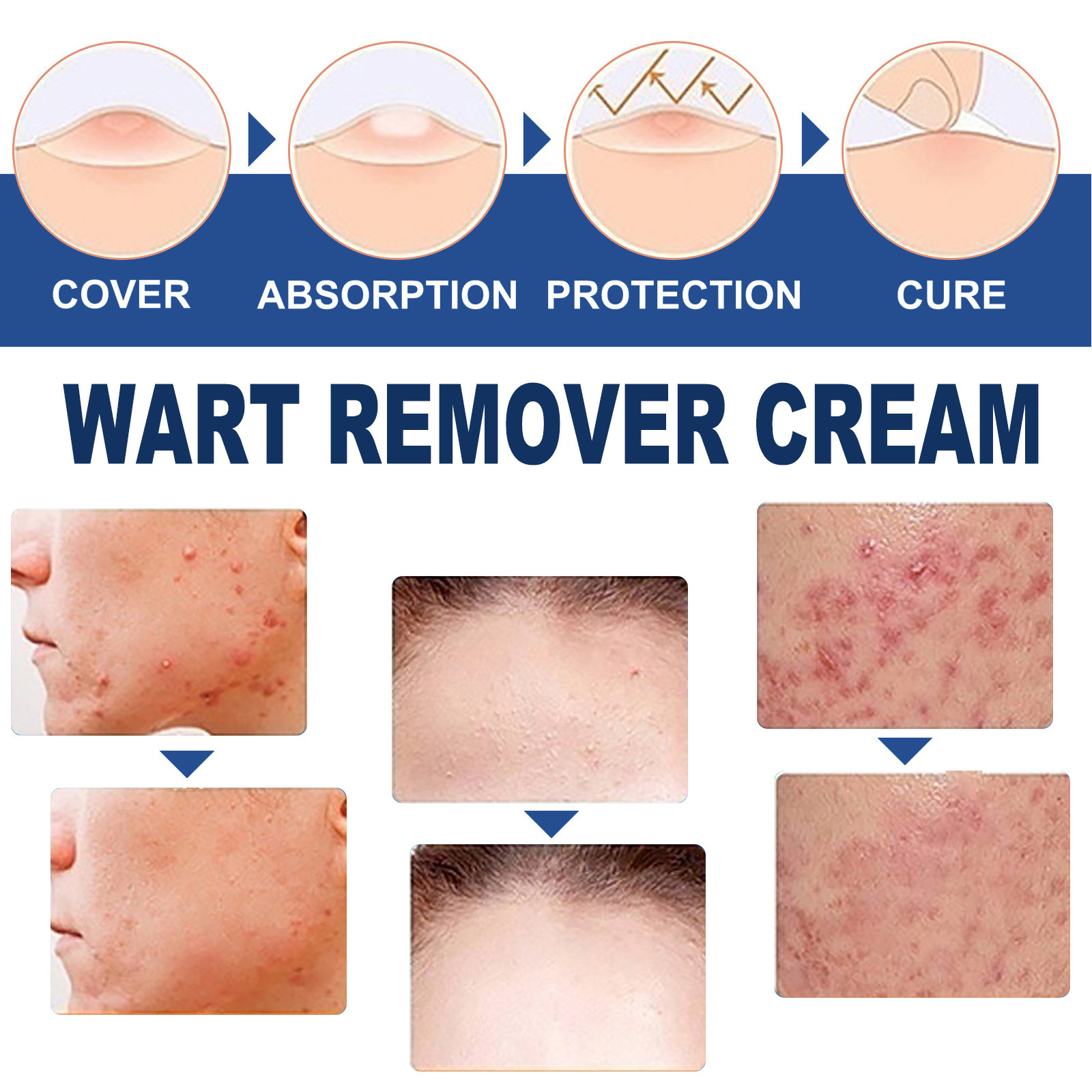 South Moon Skin Tag Remover Liquid Kit Wart and Tag Remover Wart Remover Fast Acting and Painless  for Body Anti Acne Face Cream Natural Safe Mole Remover