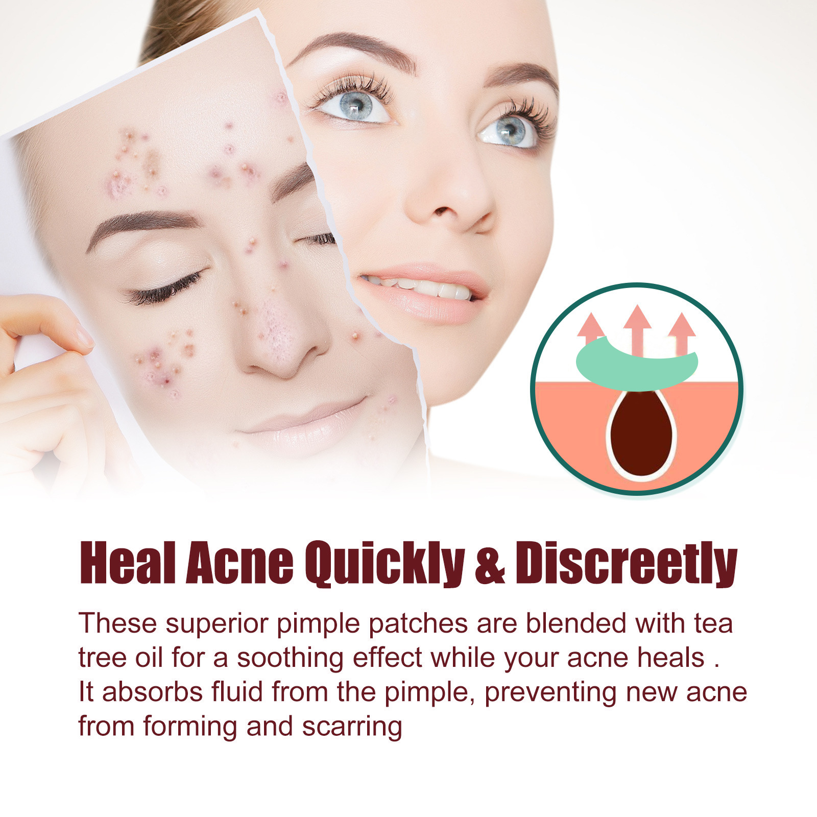 (star) Star Pimple Patch 200pcs Set Acne Invisible Acne Removal Stickers Acne Treatment Pimple Remover Concealer Face Spot Beauty Face Skin Care Makeup Tools