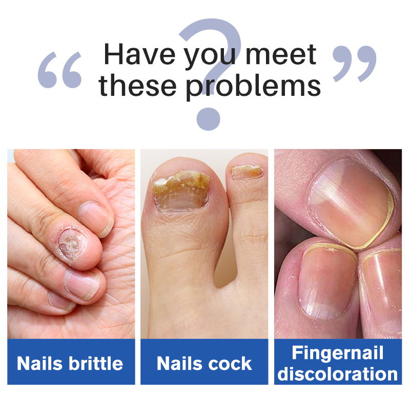 Nail Fungus Treatment Liquid Antifungal Nourishing For Brittle Damaged Toenails Fingernails Daily Home Manicure Care 30ml