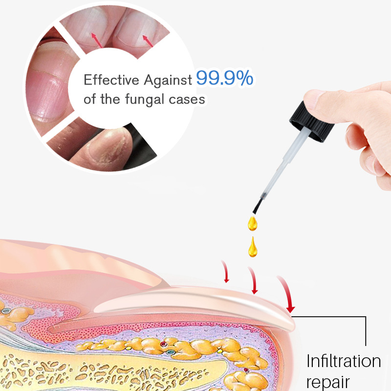 Nail Fungus Treatment Liquid Antifungal Nourishing For Brittle Damaged Toenails Fingernails Daily Home Manicure Care 30ml