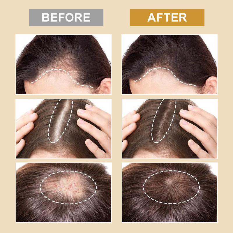 PURC Biotin Hair Growth Products for Men Women Hair Loss Treatment Fast Grow Hair Spray Regrowth Thicken Oil  Scalp Treatment Anti Hair Loss Hair Care