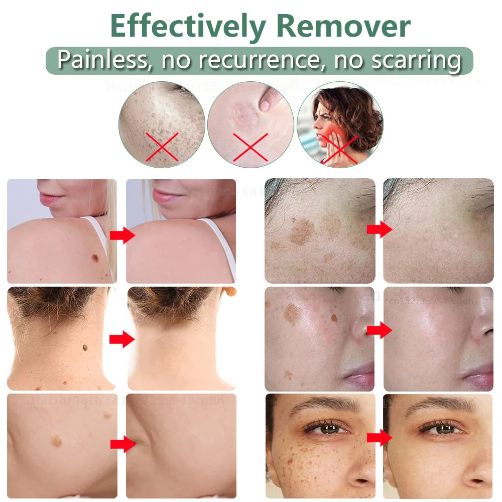 Black Dots Remover by Plasma Pen Beauty Skin Care Products Skin Tag Removal Face Cleaning Tools Tattoo Freckle Dark Spot Mole Warts Eliminator Machine