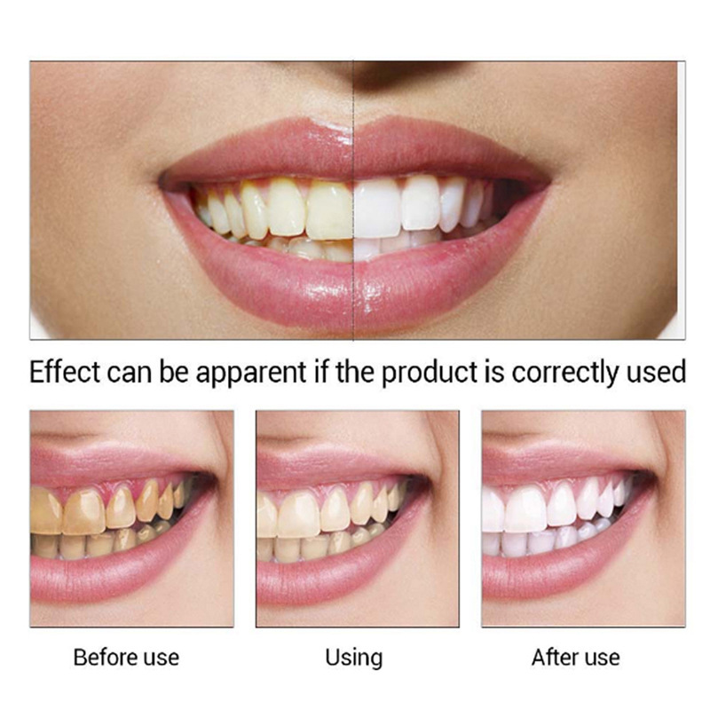 iBeaLee Teeth Whitening Essences Extra Strong White Hygiene Tooth Whitener Stain Removal