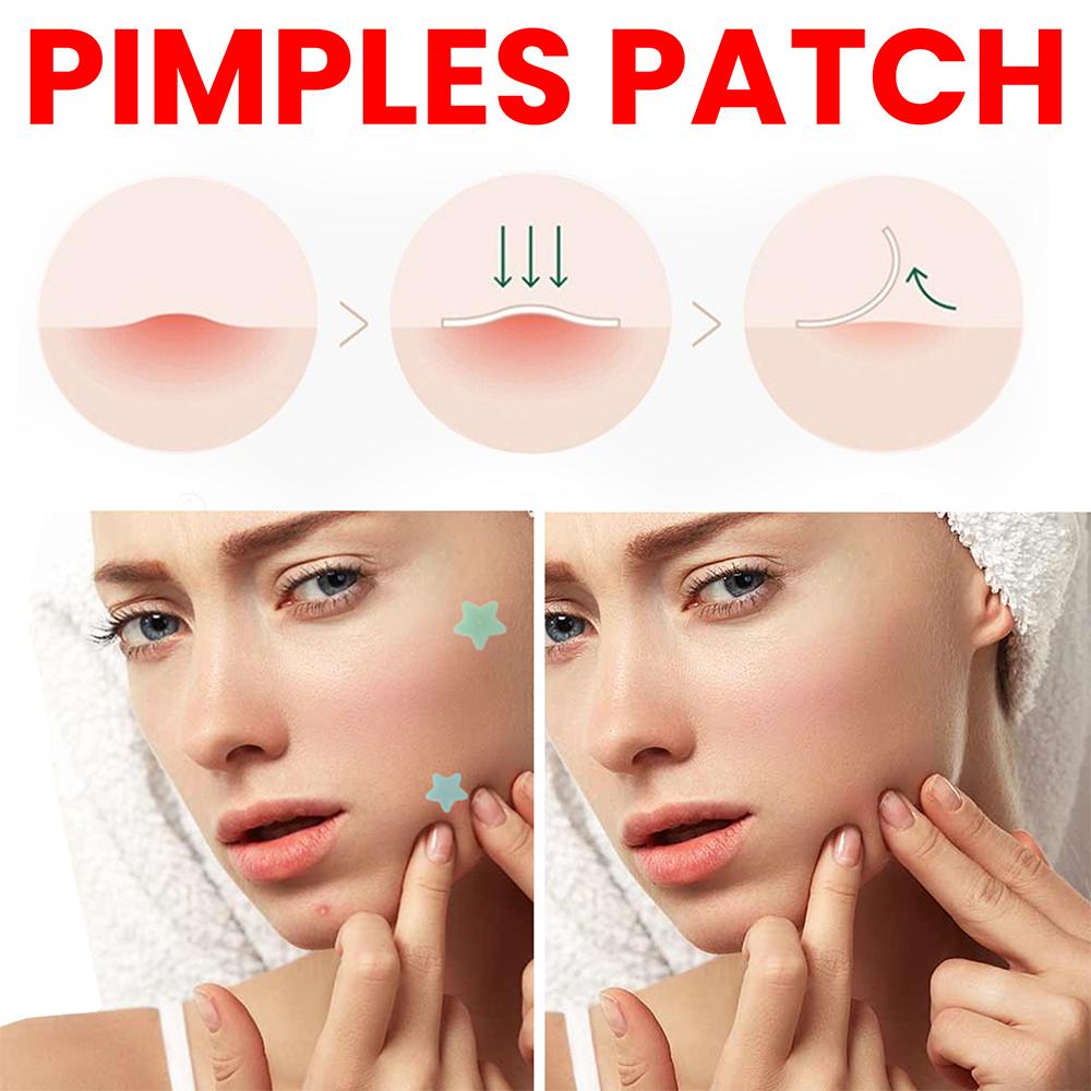 (star) Star Pimple Patch 200pcs Set Acne Invisible Acne Removal Stickers Acne Treatment Pimple Remover Concealer Face Spot Beauty Face Skin Care Makeup Tools