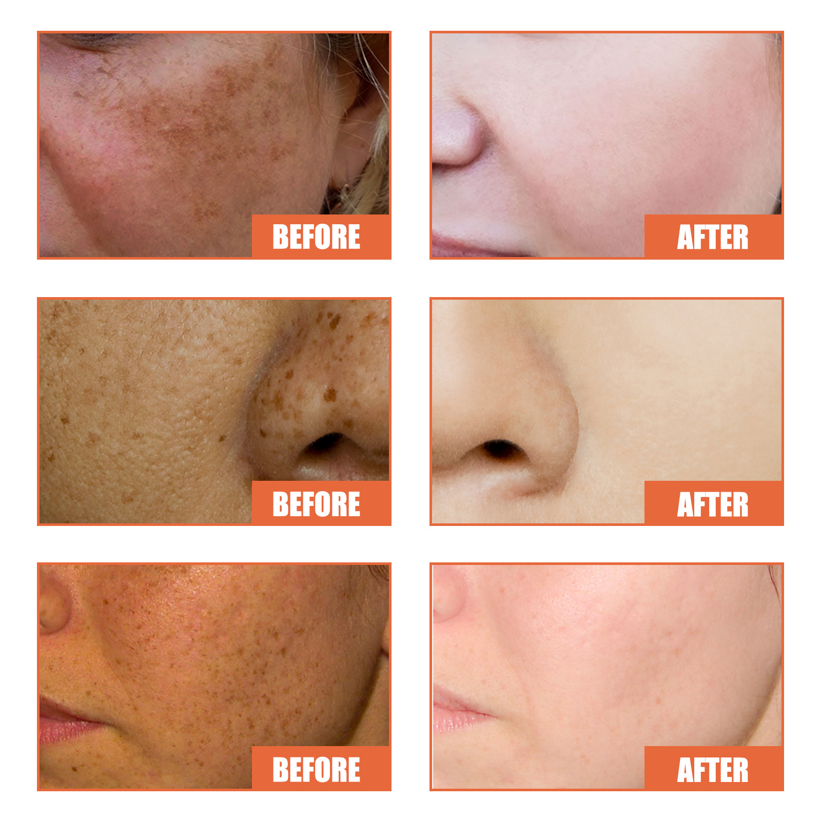 Brightening Facial Cream Whitening Moisturizing Nourishing Skin Cream Acne Dark Spot Remover Anti Age Spots Melasma Freckle Dull Complexion Removal