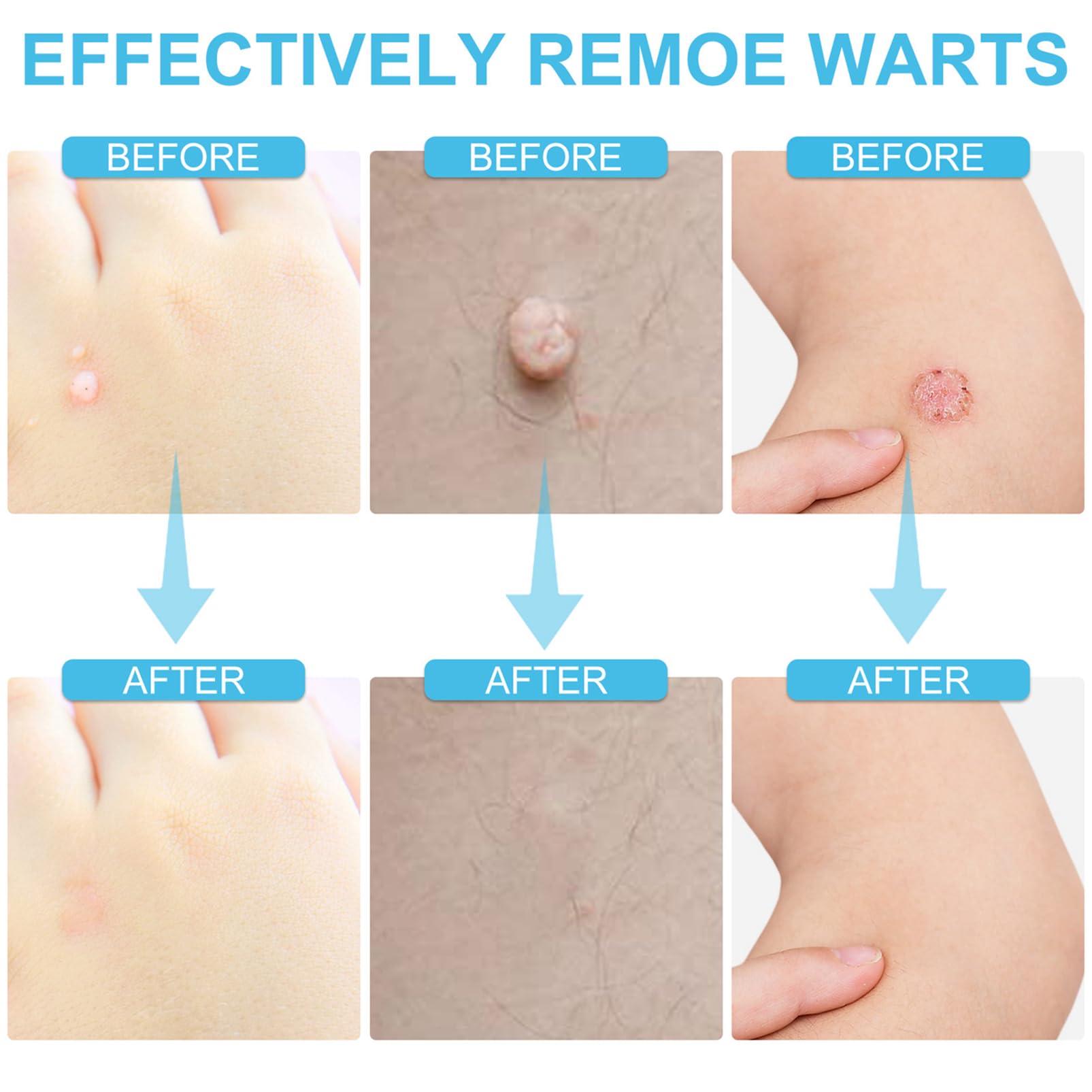 (1 pc) Skin Tag Remover Cream Painless Mole Skin Dark Spot Warts Remover Natural Skin Tag Mole Removal for Face and Body
