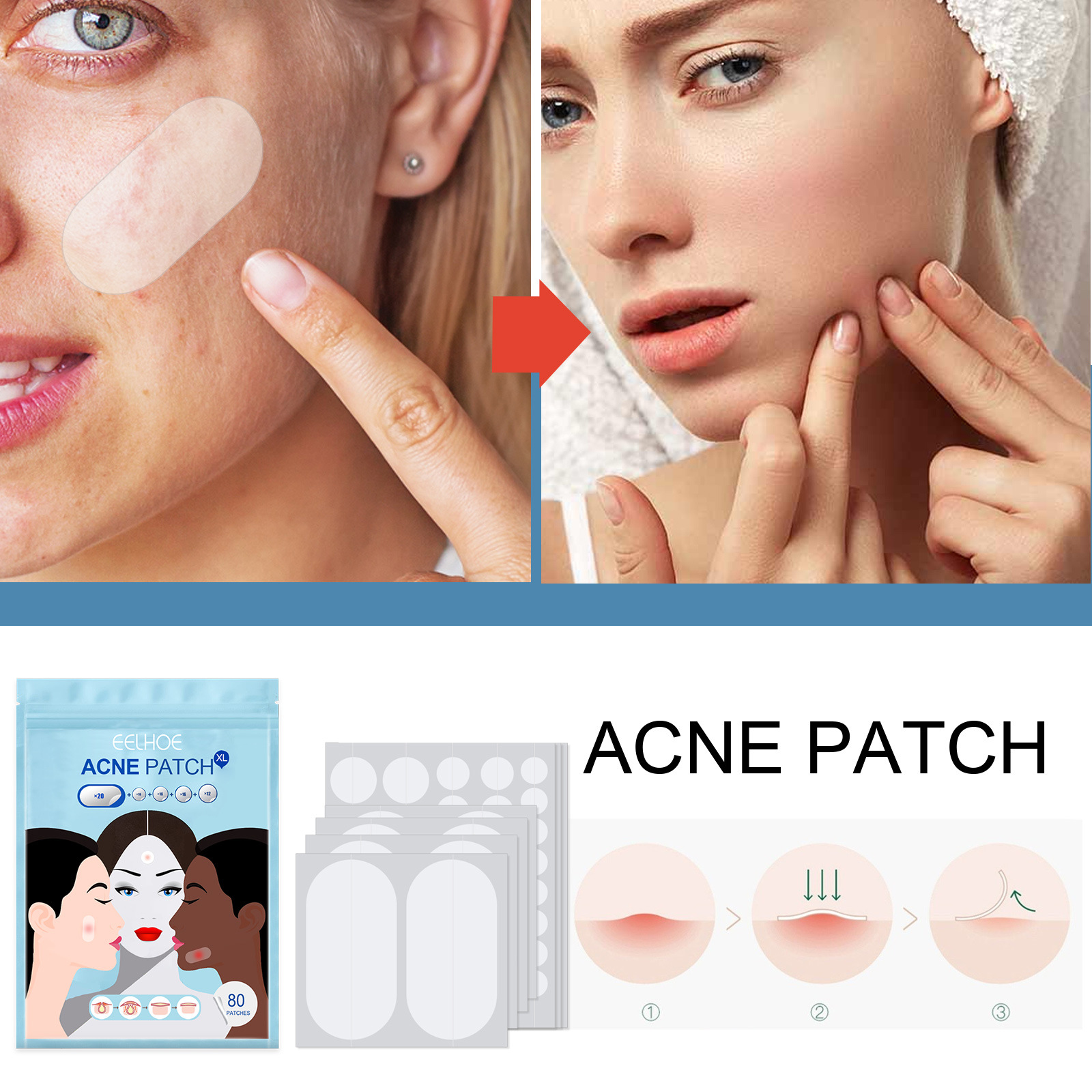 80Pcs Large Size Acne Patches Removal Pimple Anti Acne Hydrocolloid Bandage Patches Spots Marks Concealer Repair Sticker Skin Blemish Remover Skin Care