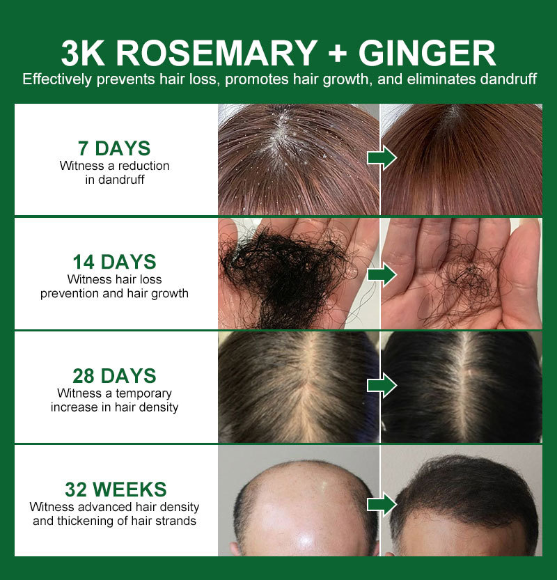 PURC Rosemary Oil Hair Growth Products for Man Women Ginger Anti Hair Loss Fast Regrowth Thicken Essential Oils Hair Serum   Scalp Treatment Hair Care