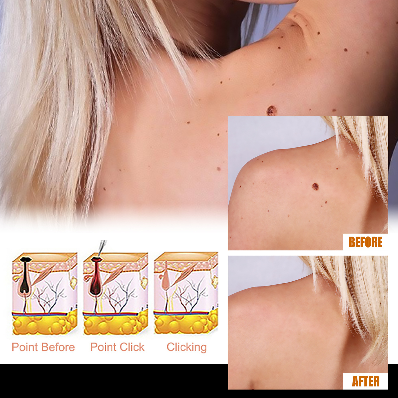 EELHOE Aclive Skin Mole Removal Essence