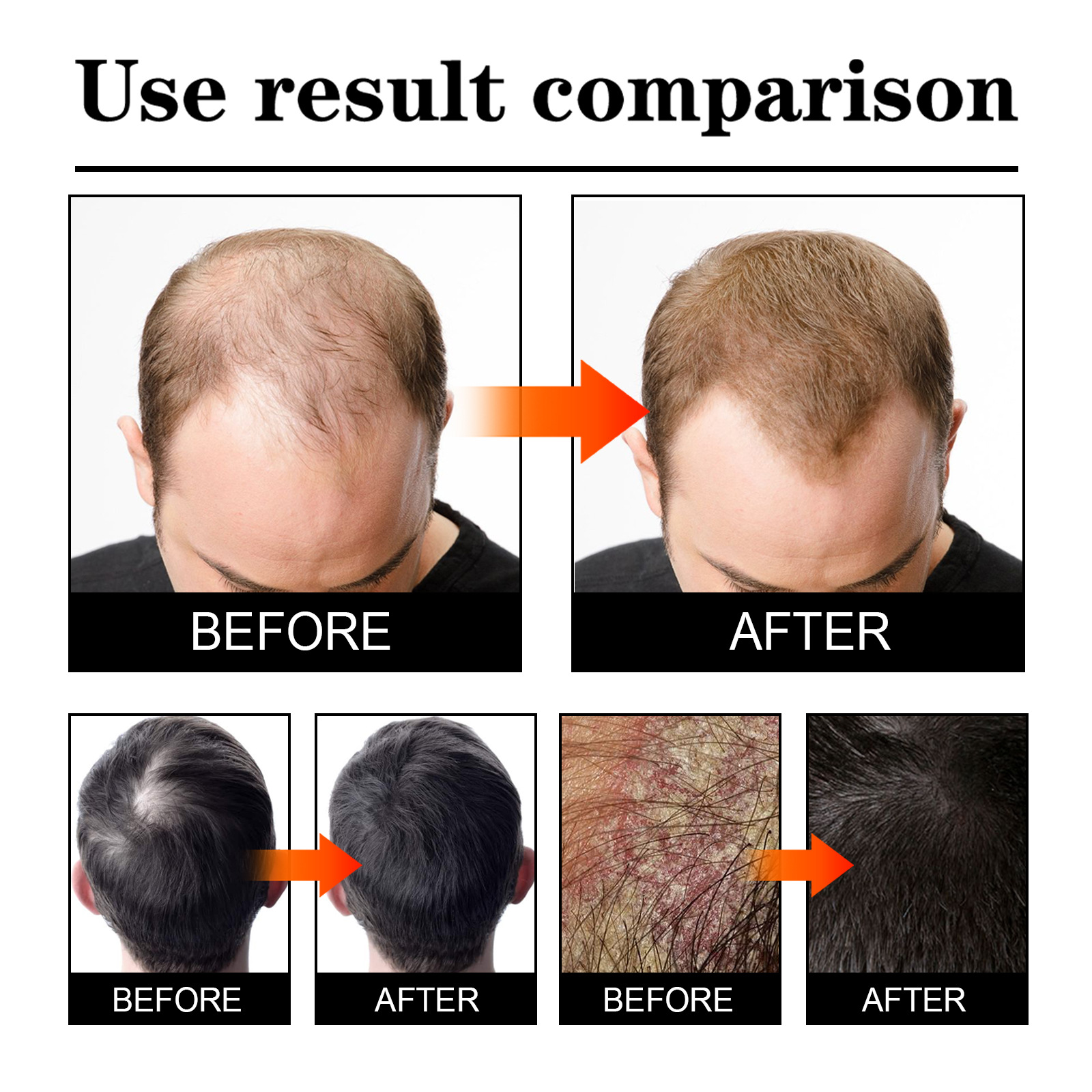 Anti Hair Loss Spray Preventing Baldness Reduce Dandruff Itching Regrowth Thicker Strengthen Nourishing Scalp Treatment Products Hair Care for Men Women