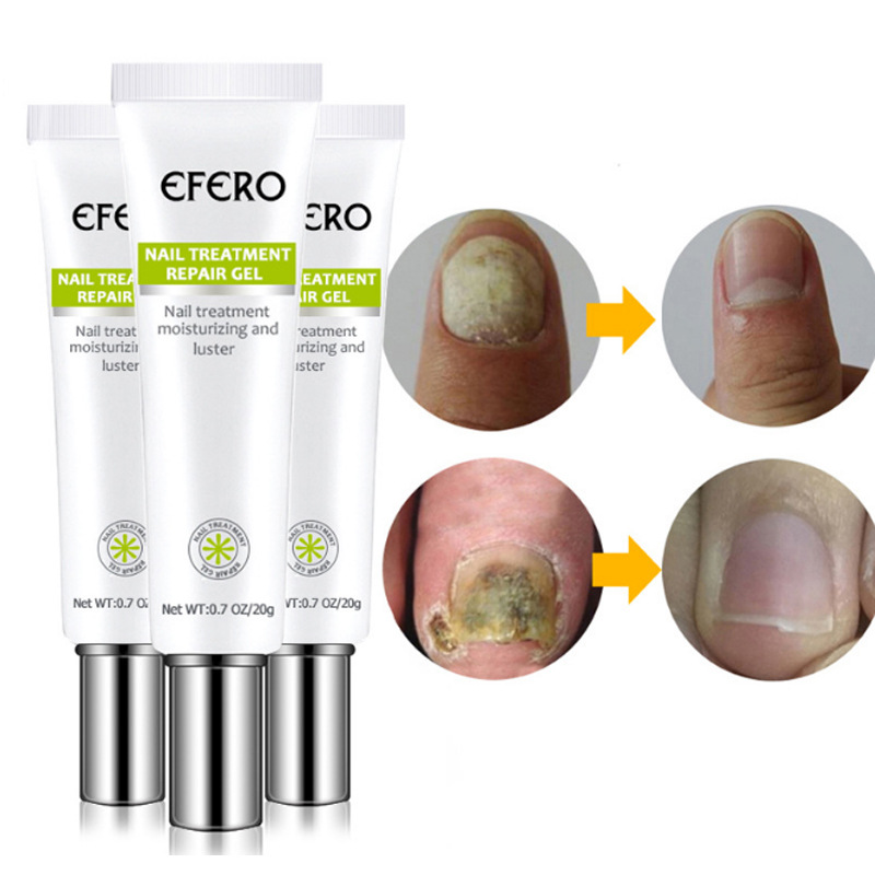 Nail Repair Cream Moisturizing Strengthening For Brittle Damaged Nails Daily Home Manicure Care 20g